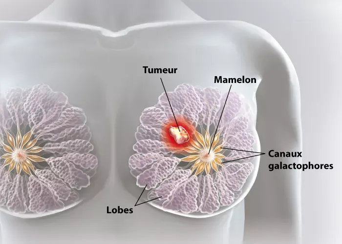 Dépistage du cancer du sein et chirurgie du sein — Casablanca